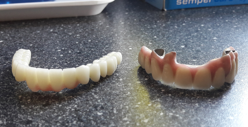 Difference bridge dentaire ceramo-metal et zircone
