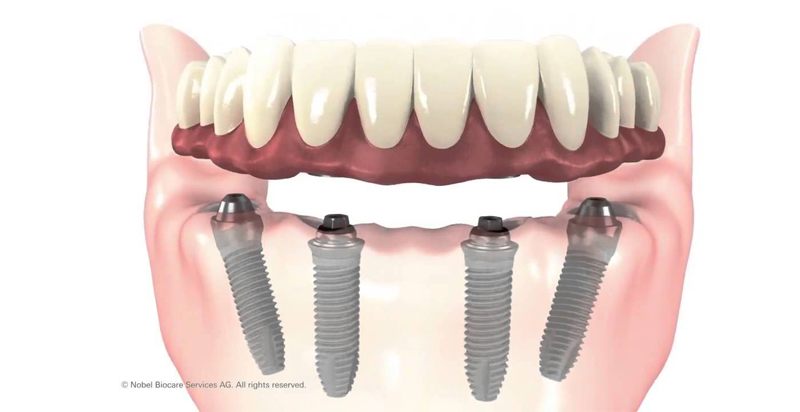 All in 4 : Prothese fixe sur 4 implants basals