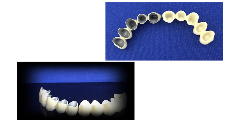 Difference bridge dentaire ceramo-metal et tout ceramique