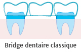 Bridge dentaire classique
