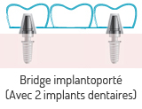 Bridge dentaire implantoporté