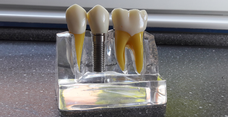 Couronne dentaire sur implant
