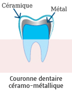 Explications couronne dentaire ceramo-metal
