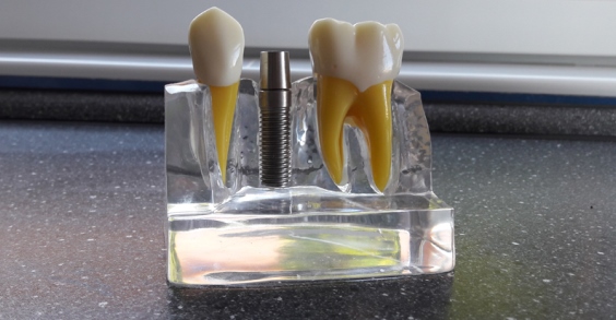 Implant dentaire titane