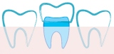 Schema couronne dentaire
