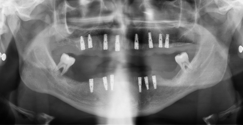 Pose des implants dentaires