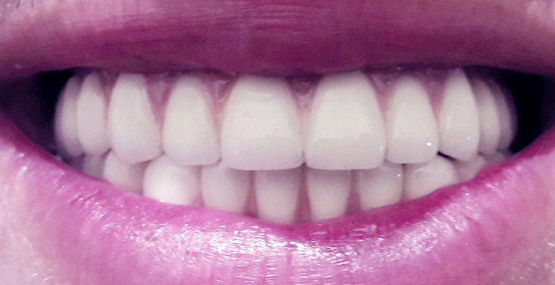 Resultat bridge dentaire sur implants